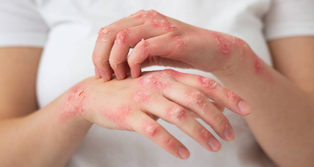 Cada 29 de junio se conmemora el Día Mundial de la Esclerodermia, una efeméride creada en 2009 con el propósito de concienciar sobre una enfermedad rara, autoinmune y poco conocida, que afecta a aproximadamente 3 de cada 100,000 personas.